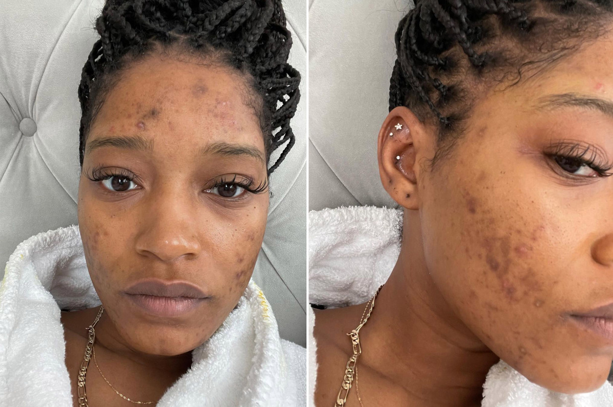 Keke Palmer Speaks Candidly About Polycystic Ovarian Syndrome and Acne